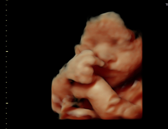 3D ultrasound image at 31 weeks